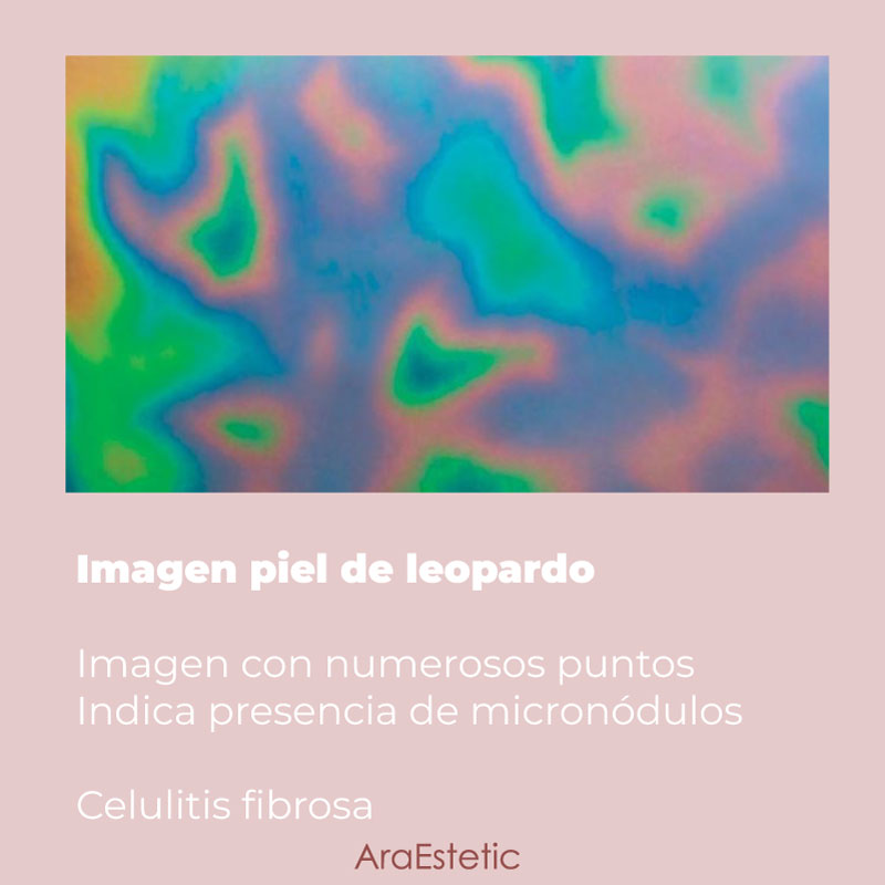 diagnóstico celulitis