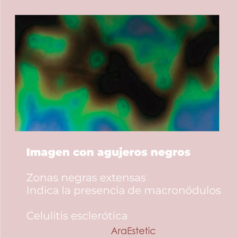 diagnóstico celulitis